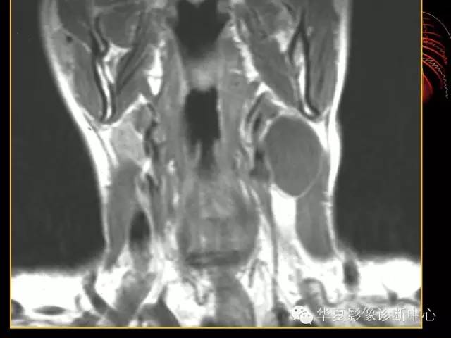 【病例】腮腺常见病变影像诊断