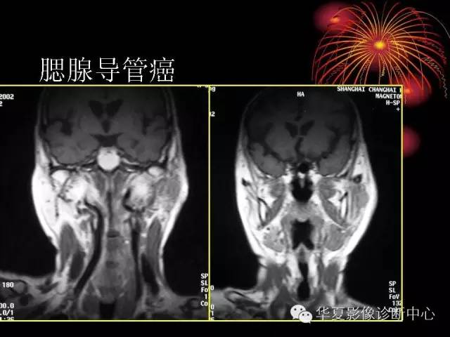 【病例】腮腺常见病变影像诊断