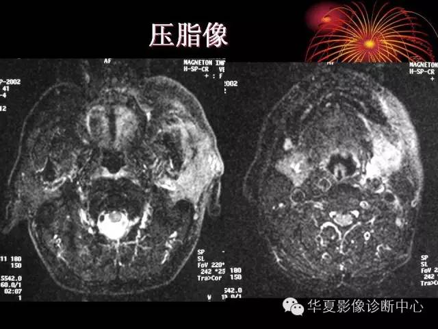 【病例】腮腺常见病变影像诊断