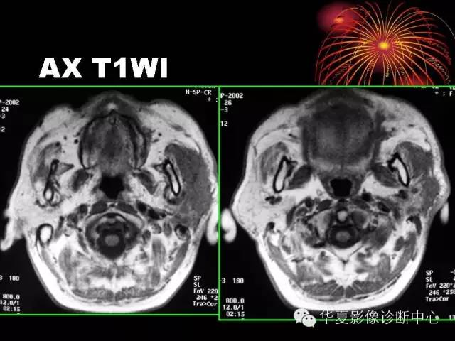 【病例】腮腺常见病变影像诊断