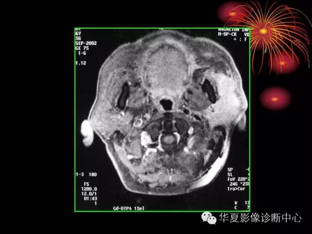 【病例】腮腺常见病变影像诊断