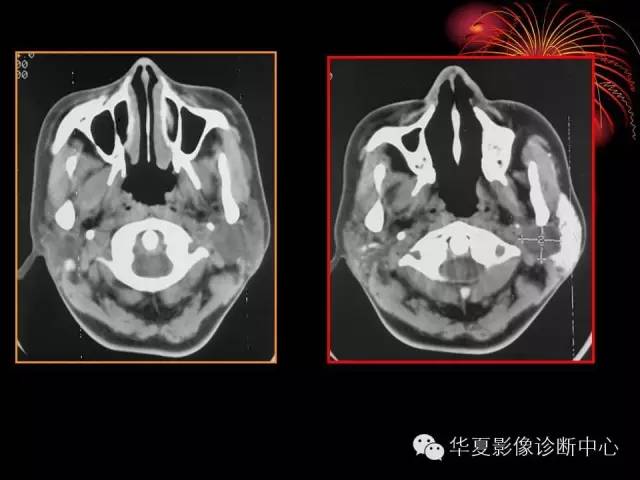 【病例】腮腺常见病变影像诊断