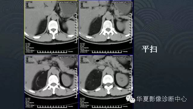 【病例】肾上腺血管平滑肌脂肪瘤1例CT影像表现