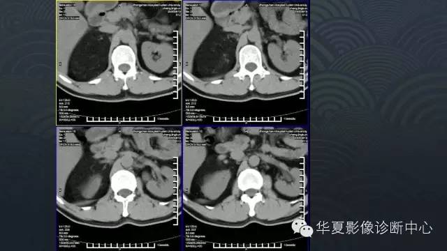 【病例】肾上腺血管平滑肌脂肪瘤1例CT影像表现
