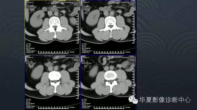 【病例】肾上腺血管平滑肌脂肪瘤1例CT影像表现
