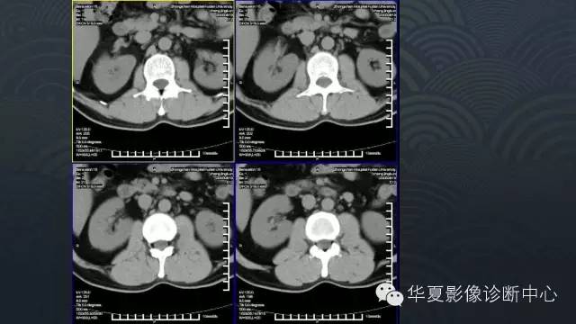 【病例】肾上腺血管平滑肌脂肪瘤1例CT影像表现