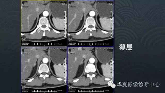 【病例】肾上腺血管平滑肌脂肪瘤1例CT影像表现