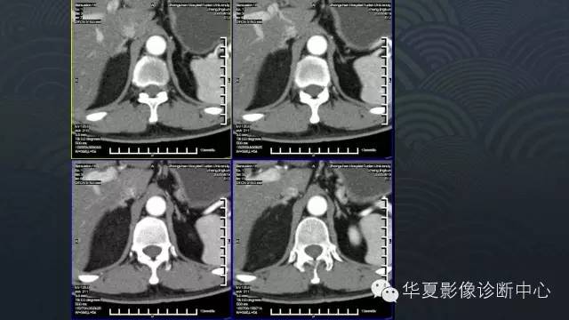 【病例】肾上腺血管平滑肌脂肪瘤1例CT影像表现