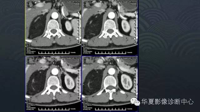 【病例】肾上腺血管平滑肌脂肪瘤1例CT影像表现