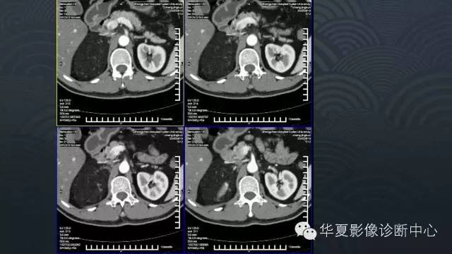 【病例】肾上腺血管平滑肌脂肪瘤1例CT影像表现