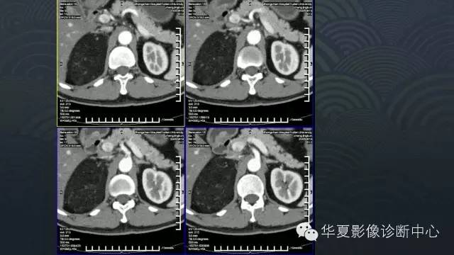 【病例】肾上腺血管平滑肌脂肪瘤1例CT影像表现