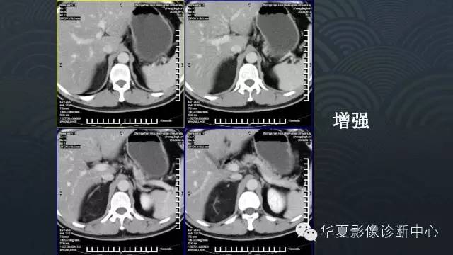 【病例】肾上腺血管平滑肌脂肪瘤1例CT影像表现
