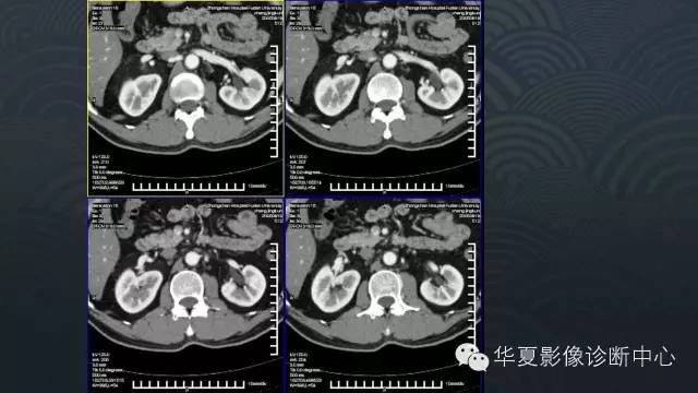 【病例】肾上腺血管平滑肌脂肪瘤1例CT影像表现