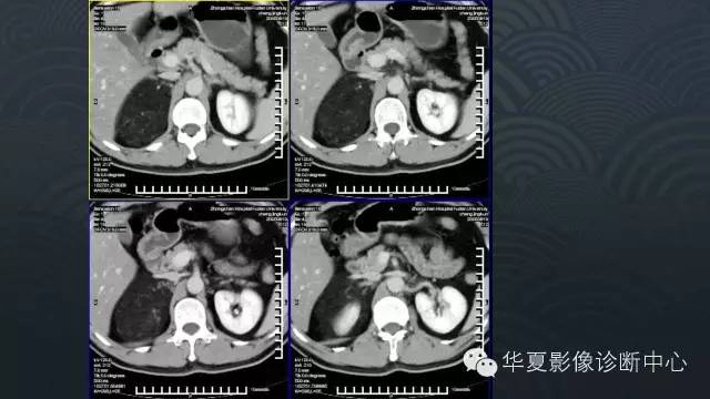 【病例】肾上腺血管平滑肌脂肪瘤1例CT影像表现