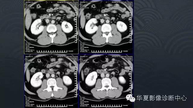 【病例】肾上腺血管平滑肌脂肪瘤1例CT影像表现
