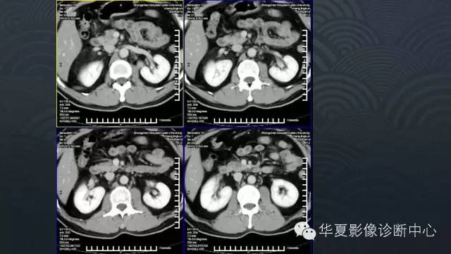【病例】肾上腺血管平滑肌脂肪瘤1例CT影像表现