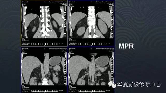 【病例】肾上腺血管平滑肌脂肪瘤1例CT影像表现