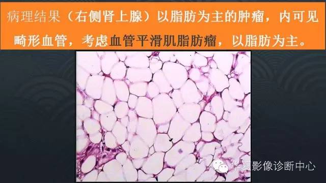 【病例】肾上腺血管平滑肌脂肪瘤1例CT影像表现