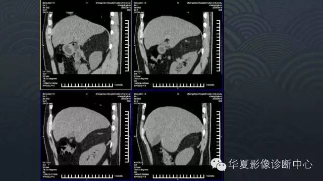 【病例】肾上腺血管平滑肌脂肪瘤1例CT影像表现