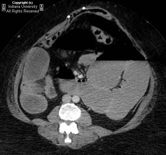 【病例】嵌顿性腹壁疝并小肠梗阻1例CT影像表现