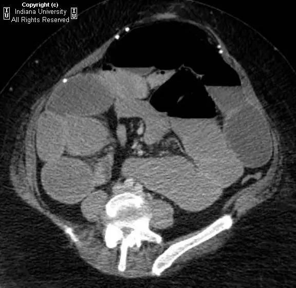 【病例】嵌顿性腹壁疝并小肠梗阻1例CT影像表现