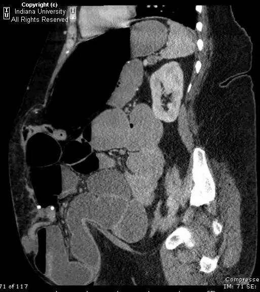 【病例】嵌顿性腹壁疝并小肠梗阻1例CT影像表现