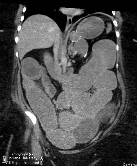 【病例】嵌顿性腹壁疝并小肠梗阻1例CT影像表现