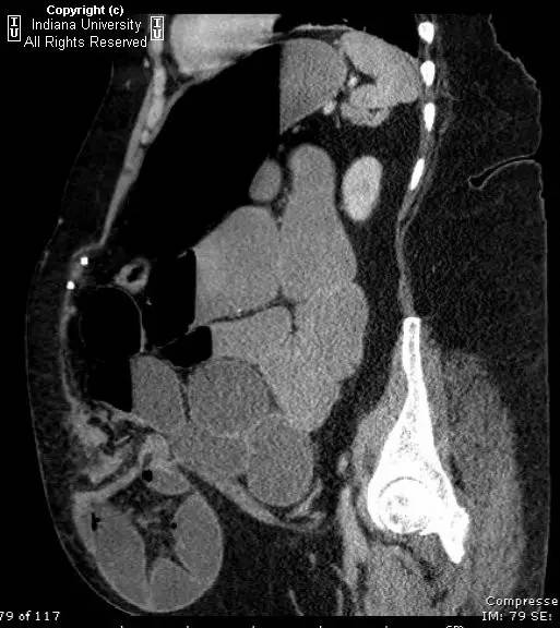 【病例】嵌顿性腹壁疝并小肠梗阻1例CT影像表现