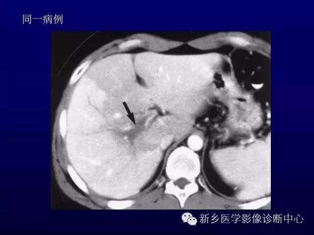 【PPT】螺旋CT动脉期在肝脏异常灌注认识中的价值