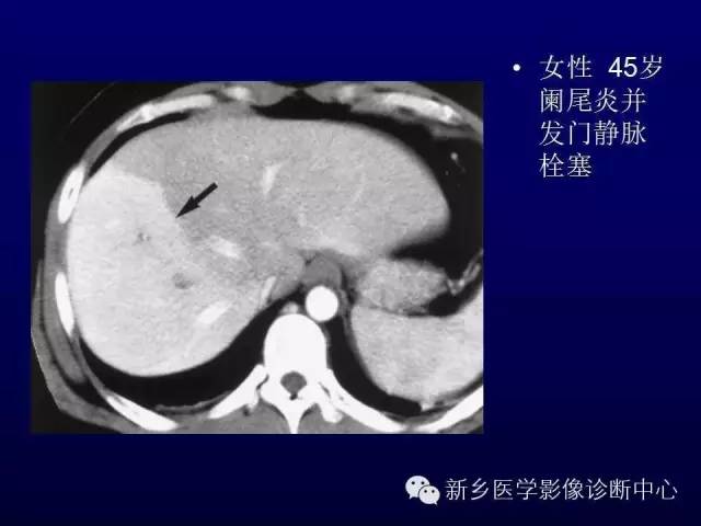 【PPT】螺旋CT动脉期在肝脏异常灌注认识中的价值