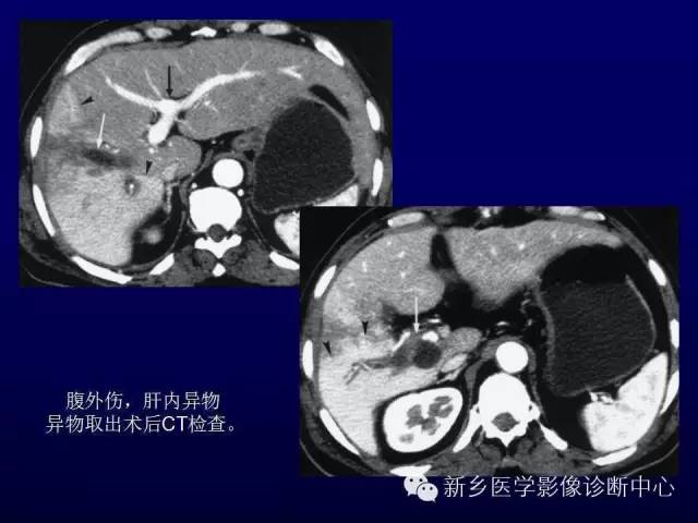 【PPT】螺旋CT动脉期在肝脏异常灌注认识中的价值