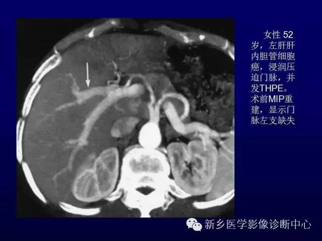 【PPT】螺旋CT动脉期在肝脏异常灌注认识中的价值