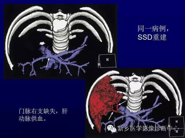 【PPT】螺旋CT动脉期在肝脏异常灌注认识中的价值