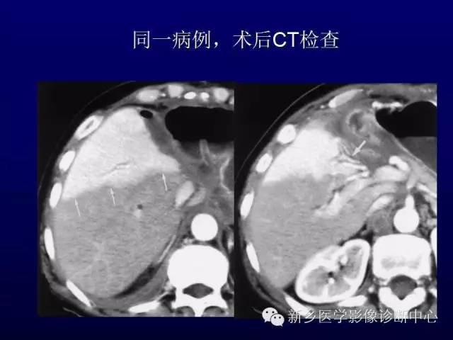 【PPT】螺旋CT动脉期在肝脏异常灌注认识中的价值