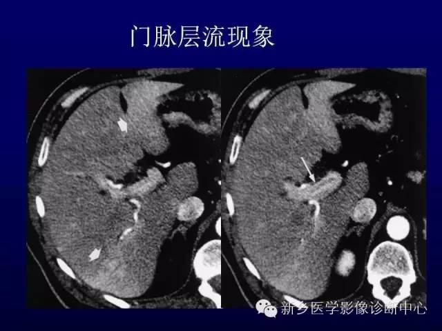 【PPT】螺旋CT动脉期在肝脏异常灌注认识中的价值
