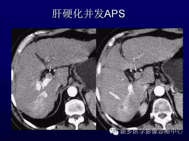 【PPT】螺旋CT动脉期在肝脏异常灌注认识中的价值