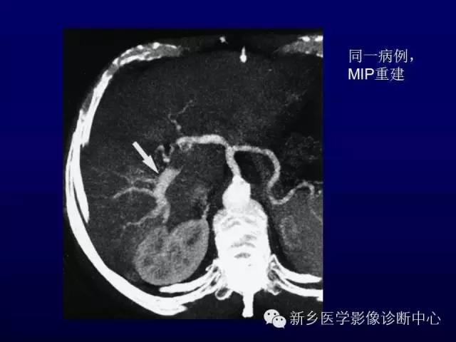 【PPT】螺旋CT动脉期在肝脏异常灌注认识中的价值