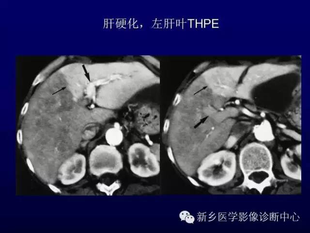 【PPT】螺旋CT动脉期在肝脏异常灌注认识中的价值