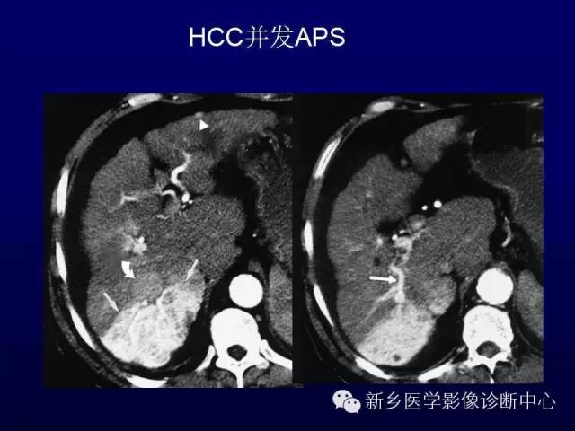 【PPT】螺旋CT动脉期在肝脏异常灌注认识中的价值