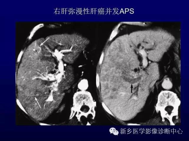 【PPT】螺旋CT动脉期在肝脏异常灌注认识中的价值