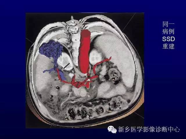 【PPT】螺旋CT动脉期在肝脏异常灌注认识中的价值