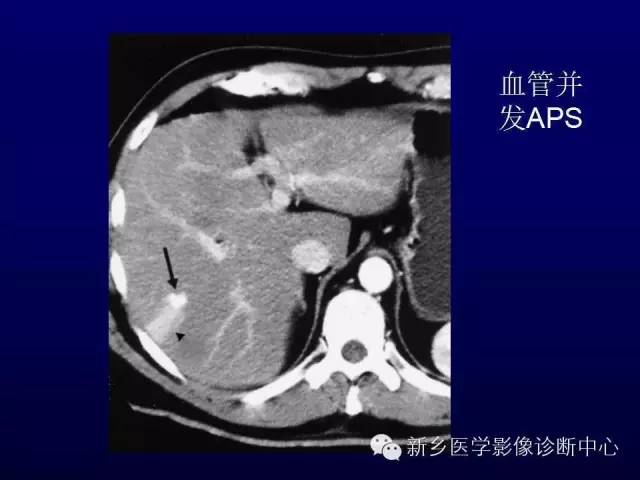 【PPT】螺旋CT动脉期在肝脏异常灌注认识中的价值