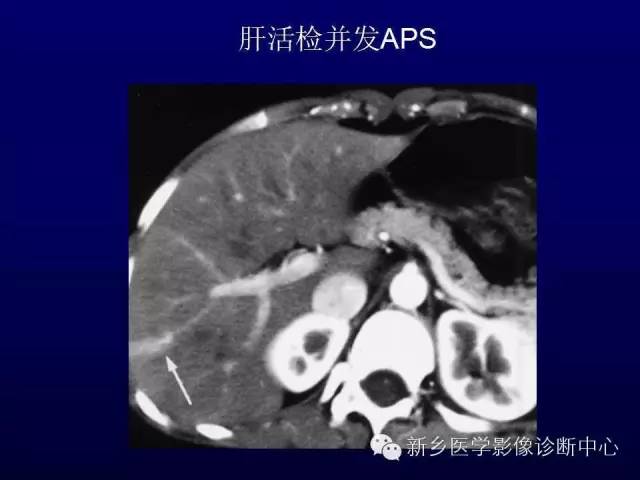 【PPT】螺旋CT动脉期在肝脏异常灌注认识中的价值