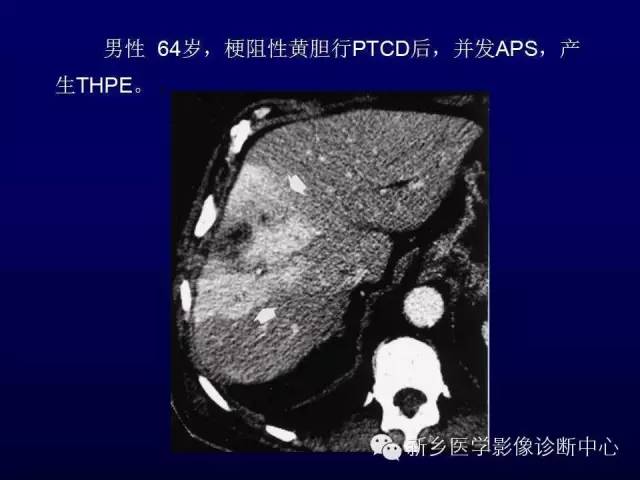 【PPT】螺旋CT动脉期在肝脏异常灌注认识中的价值