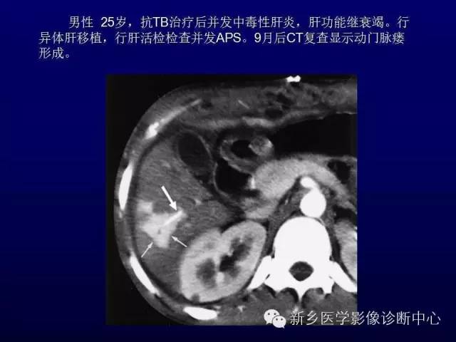 【PPT】螺旋CT动脉期在肝脏异常灌注认识中的价值