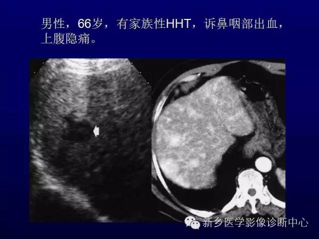 【PPT】螺旋CT动脉期在肝脏异常灌注认识中的价值
