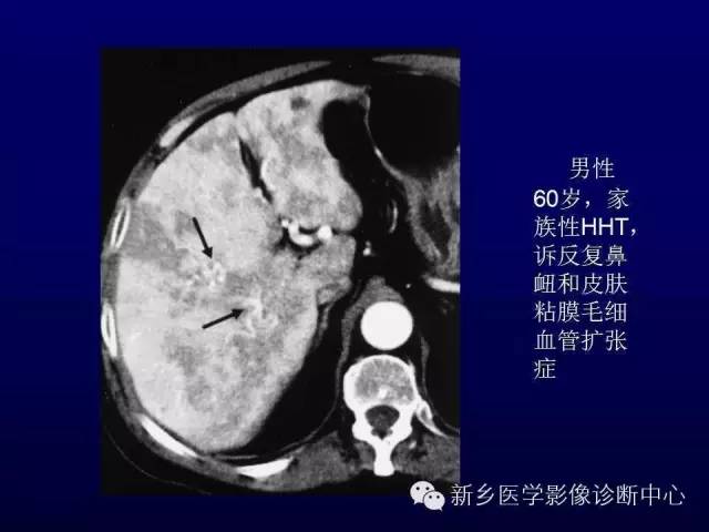 【PPT】螺旋CT动脉期在肝脏异常灌注认识中的价值
