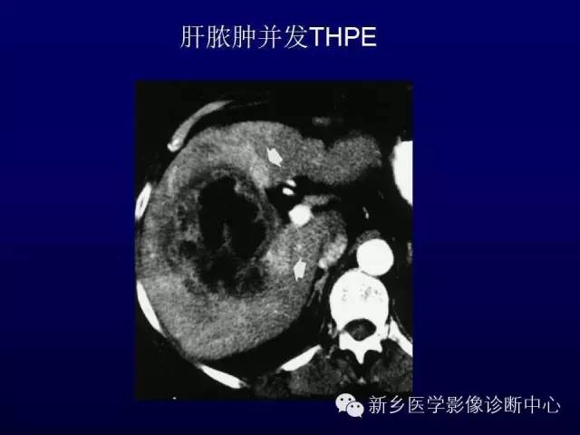 【PPT】螺旋CT动脉期在肝脏异常灌注认识中的价值
