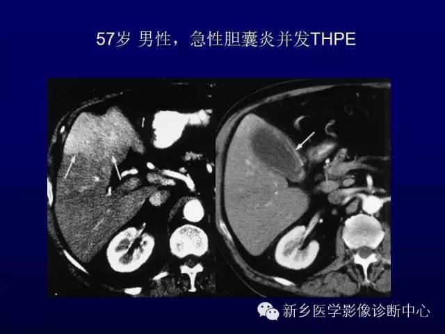 【PPT】螺旋CT动脉期在肝脏异常灌注认识中的价值