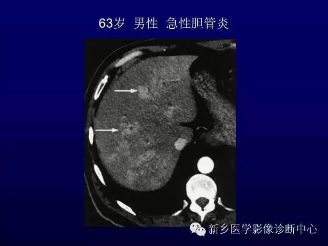 【PPT】螺旋CT动脉期在肝脏异常灌注认识中的价值